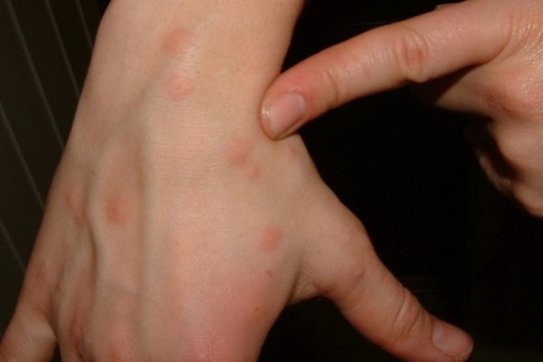 Foto: Therese Visted / Folkehelseinstituttet